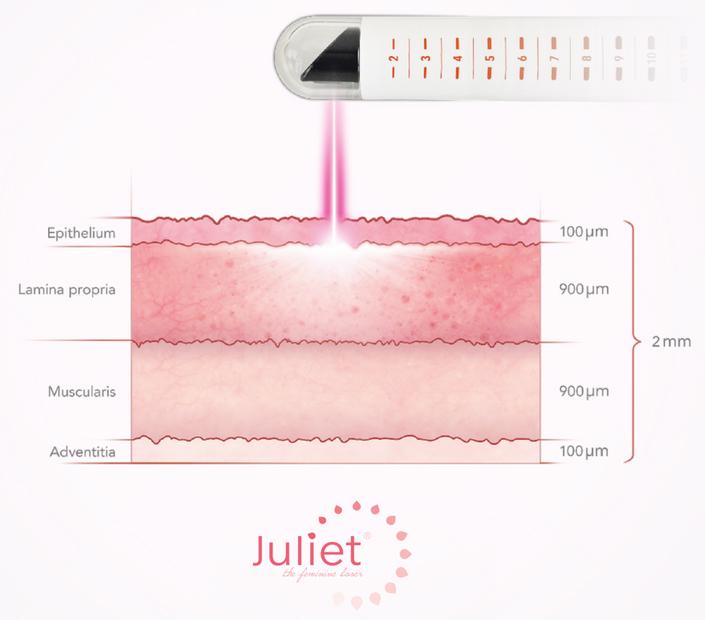 Doorsnede van de vaginawand met de vier lagen &mdash; epitheel (100 &micro;m), lamina propria (900 &micro;m), muscularis (900 &micro;m) en adventitia (100 &micro;m) &mdash; en de Juliet-laserpuls die tot 2 mm diep reikt.